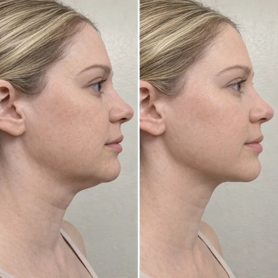 Cactox™ Snatch V-Line Mask