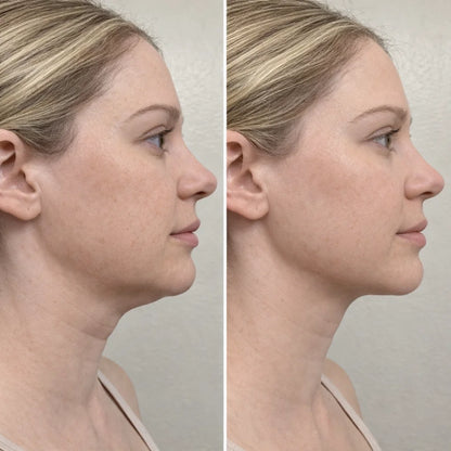 Cactox™ Snatch V-Line Mask